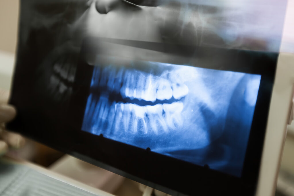 Custom Dental Crowns in St. George, Utah | Utah Dental Center