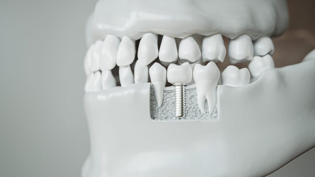 Dental Implant Procedure | Utah Dental Center, St. George