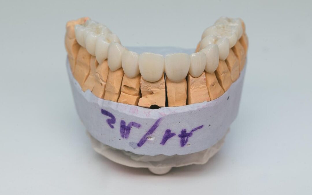 Zirconium crowns. Ceramic teeth with the implant on a plaster model isolated on white background. Ceramic bridge on plaster model