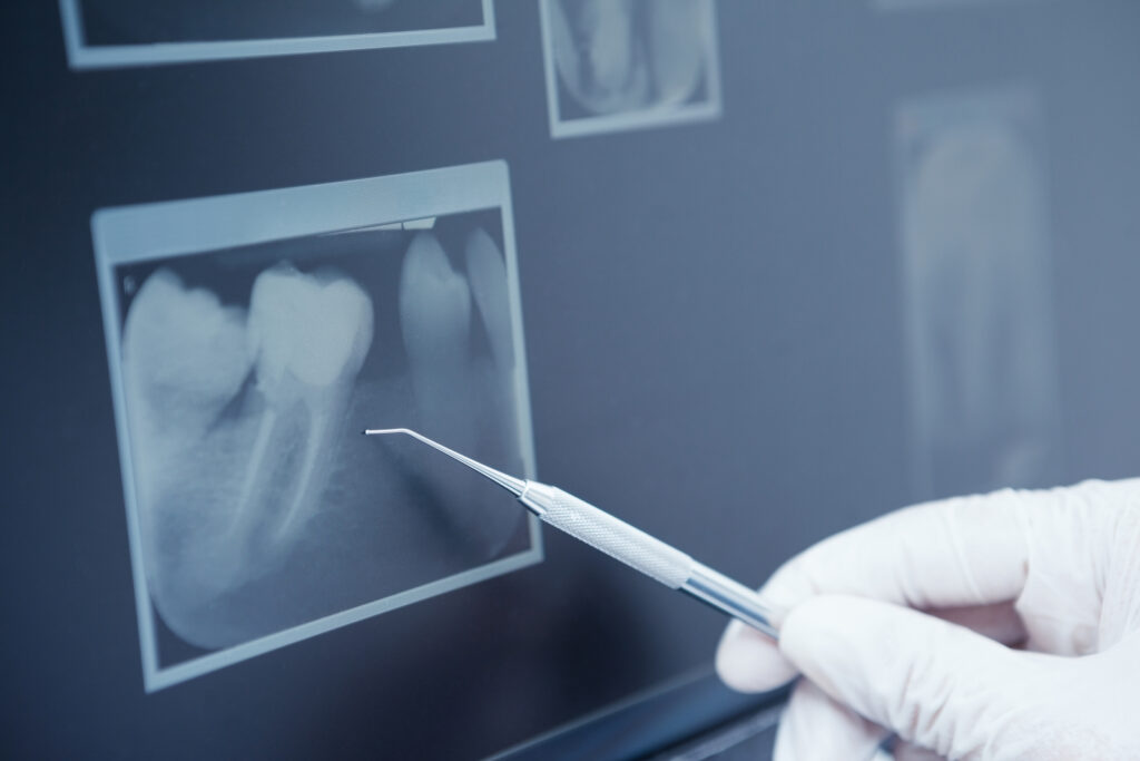Dental Crowns vs Fillings: St. George Guide | Utah Dental Center