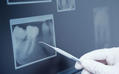 Dental Crowns vs. Fillings: What’s the Right Option for Your Tooth Repair?