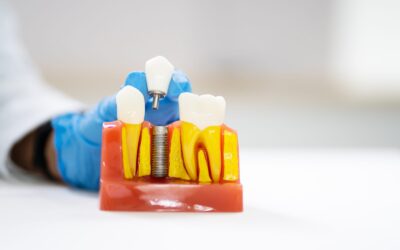 Does Dental Insurance Cover Dental Implants? What St. George Patients Should Know