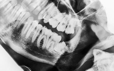 Wisdom Teeth Removal in St. George: Signs You Need It and What Recovery Looks Like