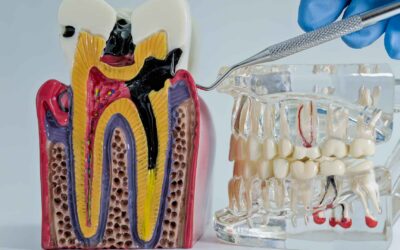 How Do I Know If I Need a Root Canal? 7 Signs to Watch For