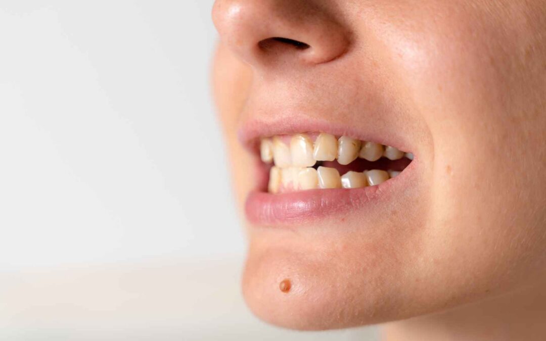 The 5 Stages of Tooth Decay_ How a Small Problem Becomes a Big One